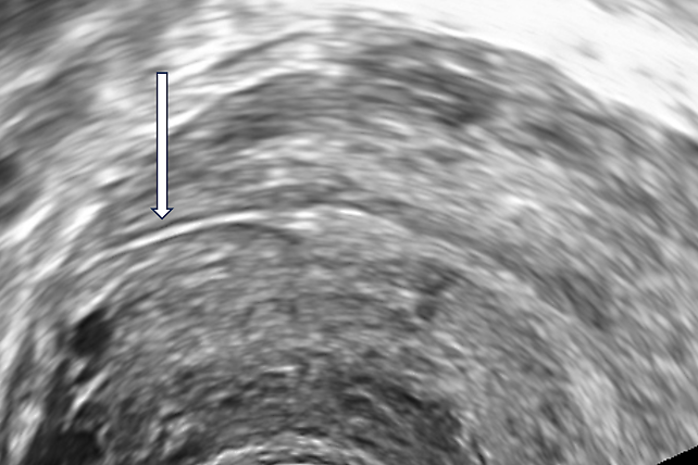 Fallopian Tube Rupturing Fallopian Tube Abnormalities on Ultrasound | Article | GLOWM